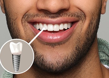 Nose-to-chin view of man smiling with one tooth indicated as an implant