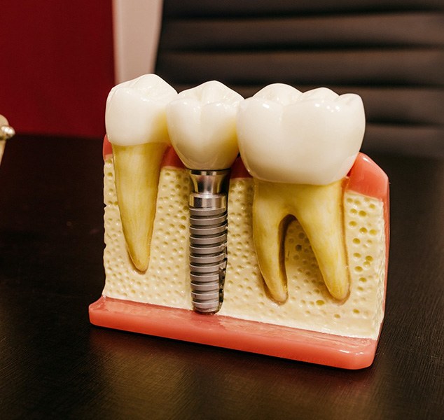 Dental implant model in dentist’s office