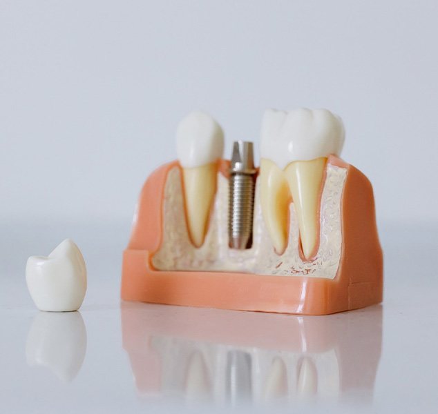 Model of dental implant components