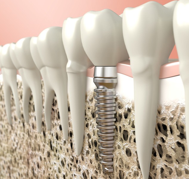 Dental implant inserted in jawbone