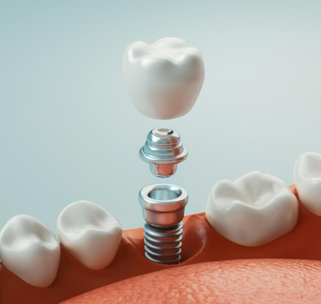 Illustrated dental implant in Springfield replacing a missing tooth