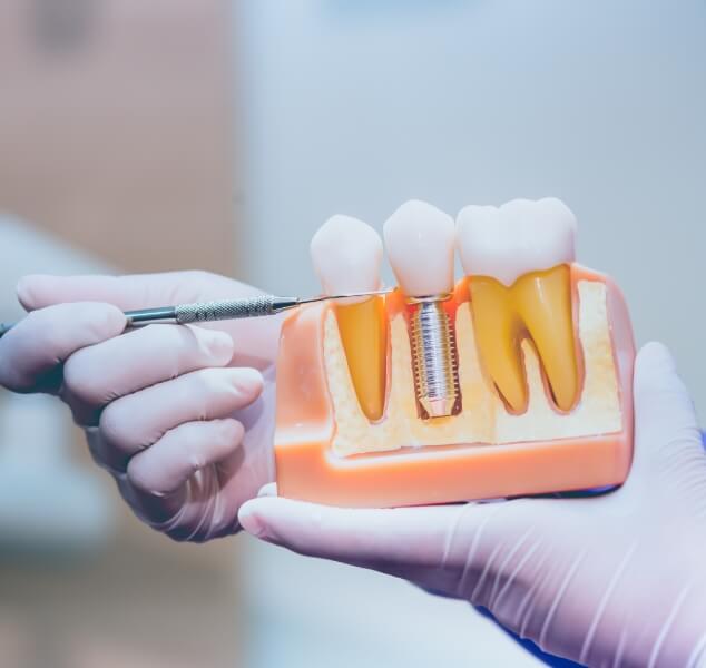 Dentist holding a model of a dental implant